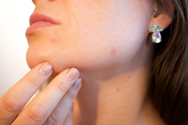 Acneea la adulti cauze prevenire si tratamente faciale acnee1